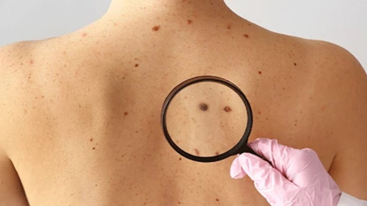 Rastreio do cancro da pele
